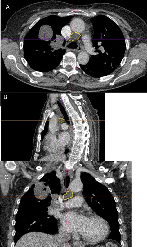 Differentiation Of Intrathoracic Lymph Node Histopathology By