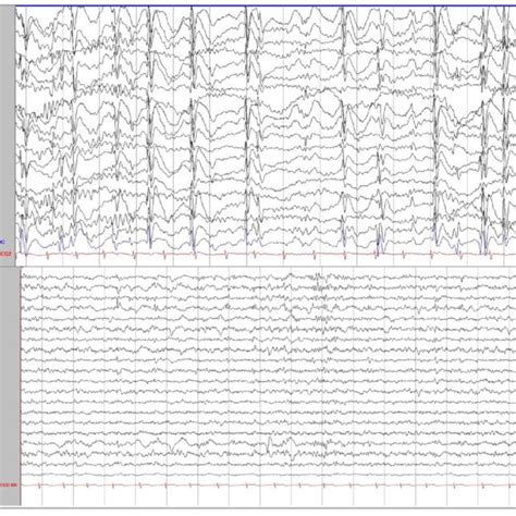 Electroencephalogram Eeg Findings Of The Patient With Doose Syndrome