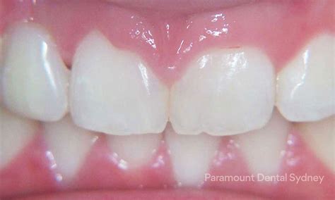 Laser Gum Reshaping And Contouring Paramount Dental Sydney — Paramount