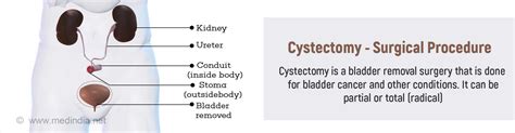 Cystectomy Indications Types Procedures Risks And Complications