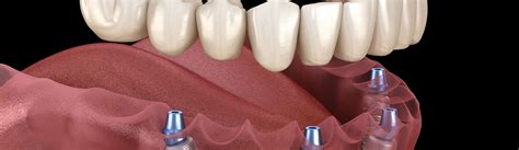 Affordable Dental Implants Woodland Hills Thousand Oaks Simi Valley