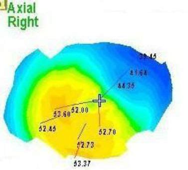 H18.711-713 Pellucid Marginal Degeneration - Decision-Maker PLUS