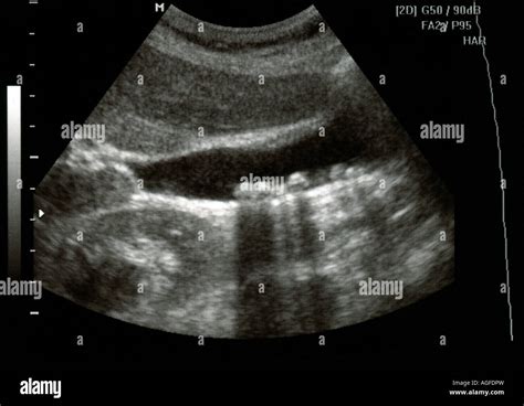 Hepatic Liver Ultrasound Showing The Gall Bladder With Multiple