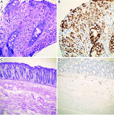 Colonic Histopathology A Colonic Biopsy Hande Stain Signet Ring Download Scientific Diagram