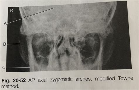 AP Axial Zygo Arches Modified Townes Diagram Quizlet