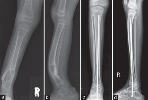 Cpt Code For Distal Tibial Intramedullary Nailing Bios Pics