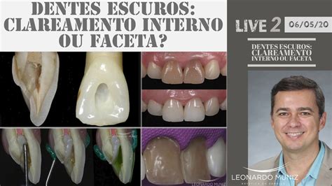 Dentes escuros clareamento interno ou facetas Conteúdo Live 2 YouTube