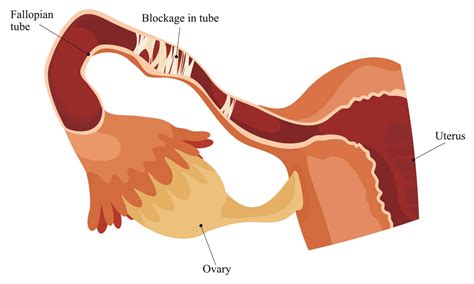 Blocked Fallopian Tube Causes Treatment And Fertility Afgc