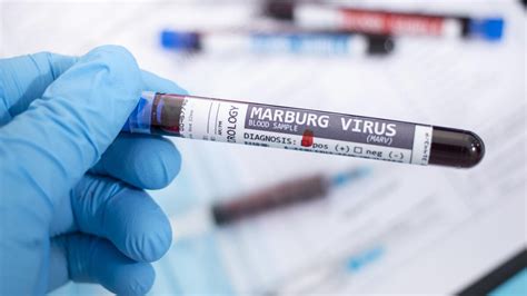 Untreatable Deadly Marburg Virus Spreading - Here's What To Know | iHeart