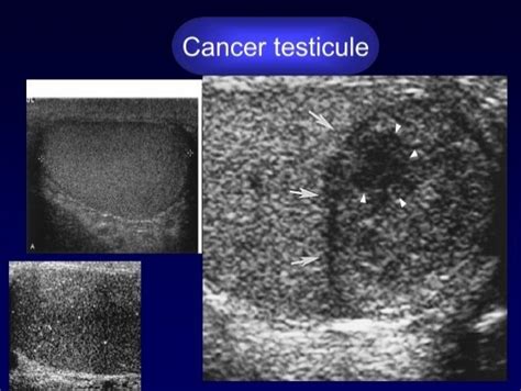 Cancer Testicule