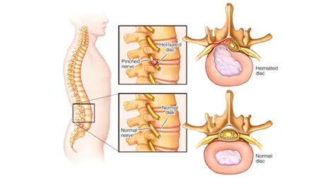 Pinched Nerve - TriMed Spine & Joint