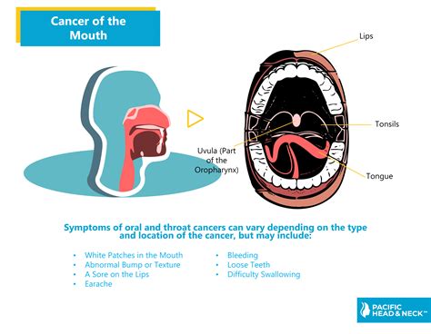 Uvula Cancer