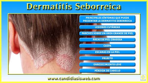 Enfermedades Por Hongos Dermatitis Seborreica 22275 The Best Porn Website