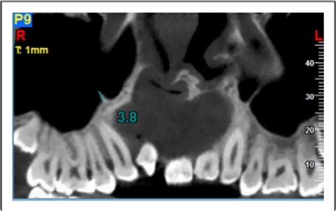 Figure 1 From Prevalence And Features Of Maxillary Sinus Septa In Patients With Cleft Lip And