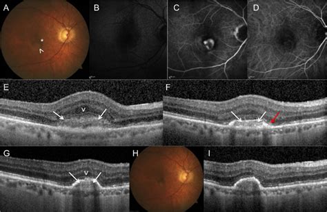 Multimodal Imaging Of Neovascular Amd Of The Right Eye Best Corrected