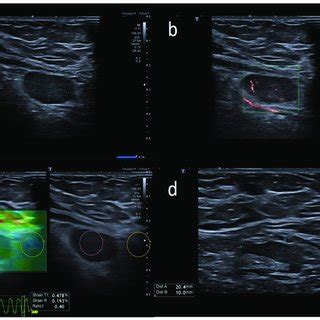 49-year-old female with unilateral left axillary adenopathy noted 6... | Download Scientific Diagram