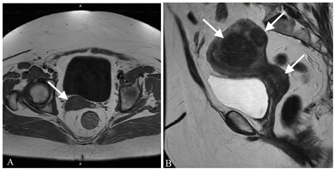 Ijerph Free Full Text Rhabdomyosarcoma Of The Cervix In A Post