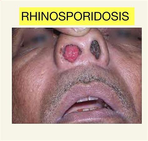 Rhinosporidiosis Medizzy