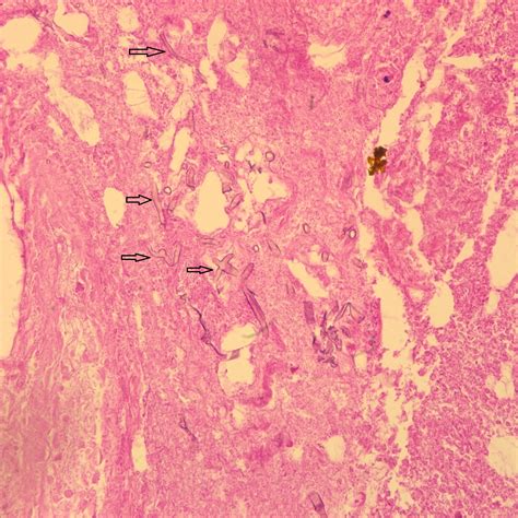 A 21 Year Old Man With Persistent Worsening Calf Pain JBJS Image Quiz