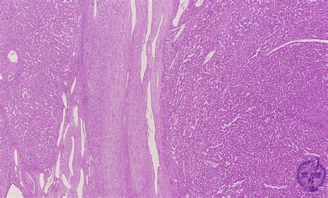 10liver 12 Hepatocellular Carcinomapathology Core Pictures