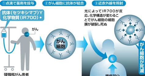 がんが治る 見つかる：光免疫療法 「光と薬」で狙い撃ち＝編集部 週刊エコノミスト Online