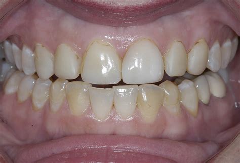 Before And After Gallery Envision Dental Dentist In Marietta Ga