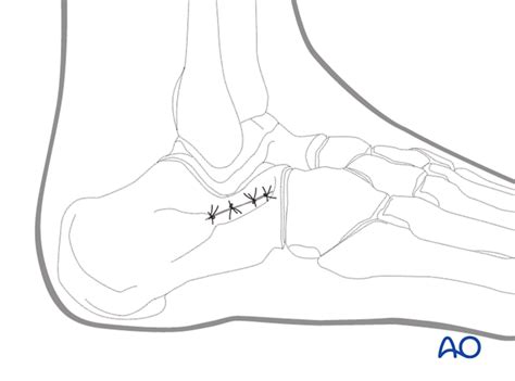 Sinus tarsi approach to the calcaneus