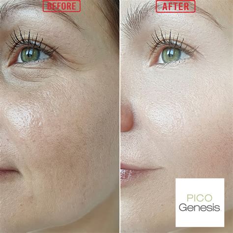 pico genesis  pico fx   lighten  complexion