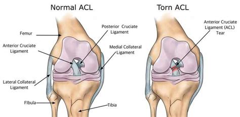 What can be done for an ACL Tear? ACL Tear surgery at JaipurJoints.