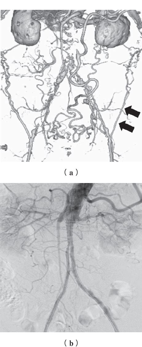 Figure 1 from Treatment Strategy for Leriche Syndrome Complicated with ...