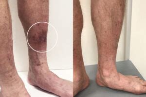 Why Does Hyperpigmentation Occur After Sclerotherapy Vein Health