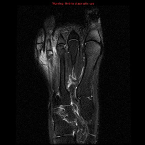 Bursitis MRI - wikidoc