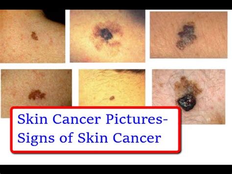 Skin Cancer Signs And Symptoms