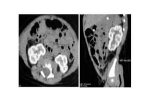 Combined liver and kidney transplant.pptx