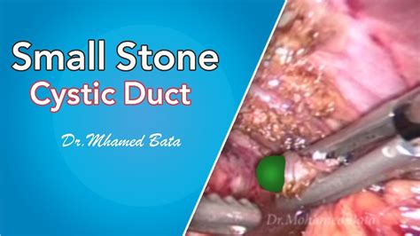 Small Stone In Cystic Duct Youtube