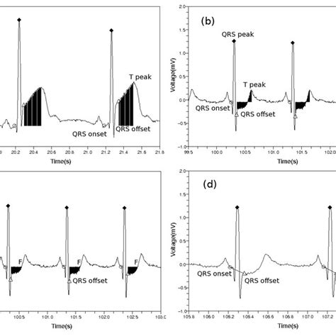 3: Removing baseline wandering in ECG. (a) Discrete wavelet transform ...