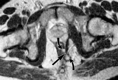 Mr Imaging Classification Of Perianal Fistulas And Its Implications For Patient Management