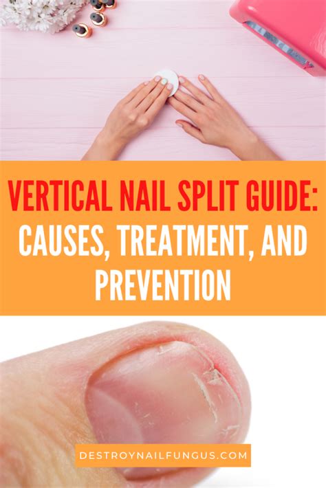 How To Fix A Vertical Nail Split A Comprehensive Guide