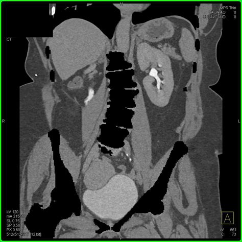 Scarring Right Kidney With Subtle Filling Defects In Right Ureter