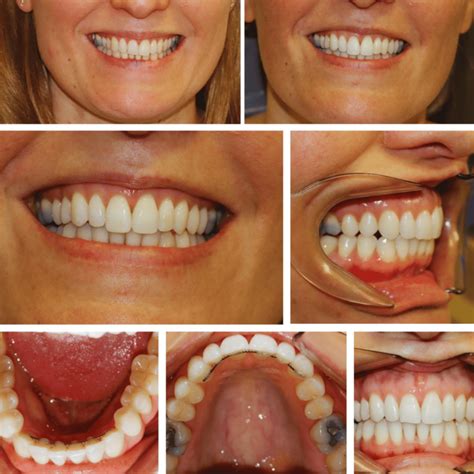 Case 2 Invisalign Merrow Park Dental Dentist In Guildford Surrey