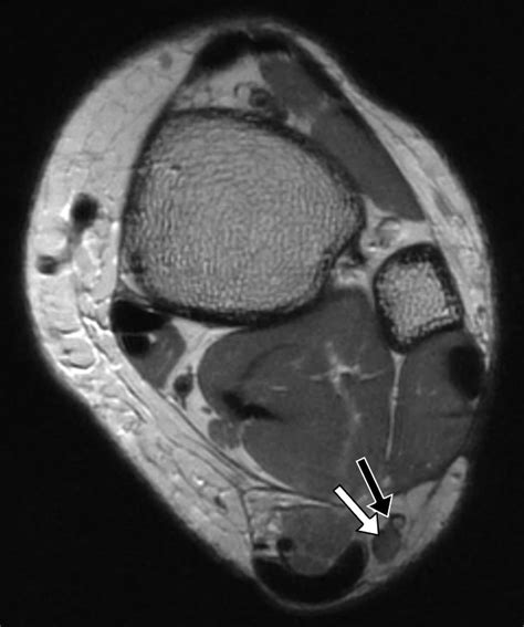 Pins And Needles From Fingers To Toes High Resolution Mri Of