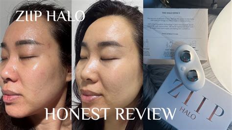 Honest Review Ziip Halo Before And After Pics How I Use Is It