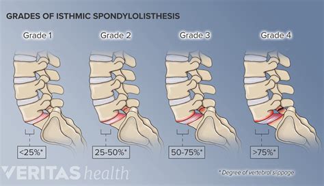 All About L5 S1 Lumbosacral Joint Spine Health