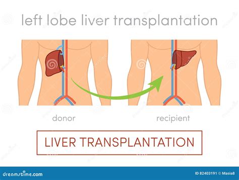 Liver Transplantation Concept Stock Illustration Illustration Of