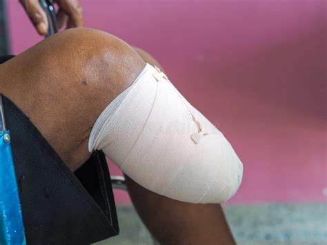 Elastic Bandaged Below Knee Amputation Stock Image Image Of Care Adult 215077213