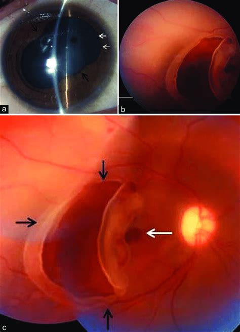 A Slit Lamp Photograph Of The Right Eye At Presentation Showing