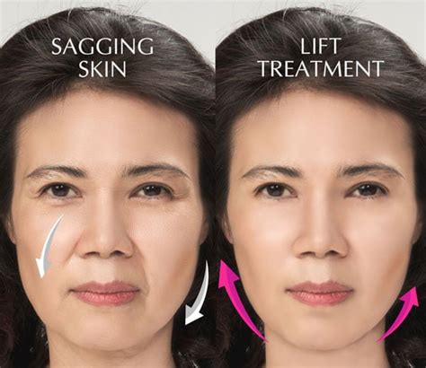 Thread Lift Treatment | Best Face Lifting & Tightening Malaysia