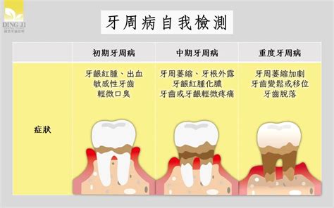 一分鐘了解牙周病的原因擊退牙周病看這裡鼎吉牙醫診所