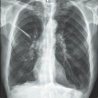 A Postero Anterior Radiograph Of The Chest Control View For A Barium