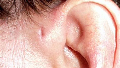 Agujero En La Oreja Fosa Preauricular Lo Que Debe Saber Salud Tudo